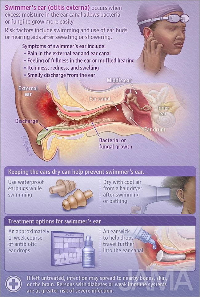 Swimmer's ear