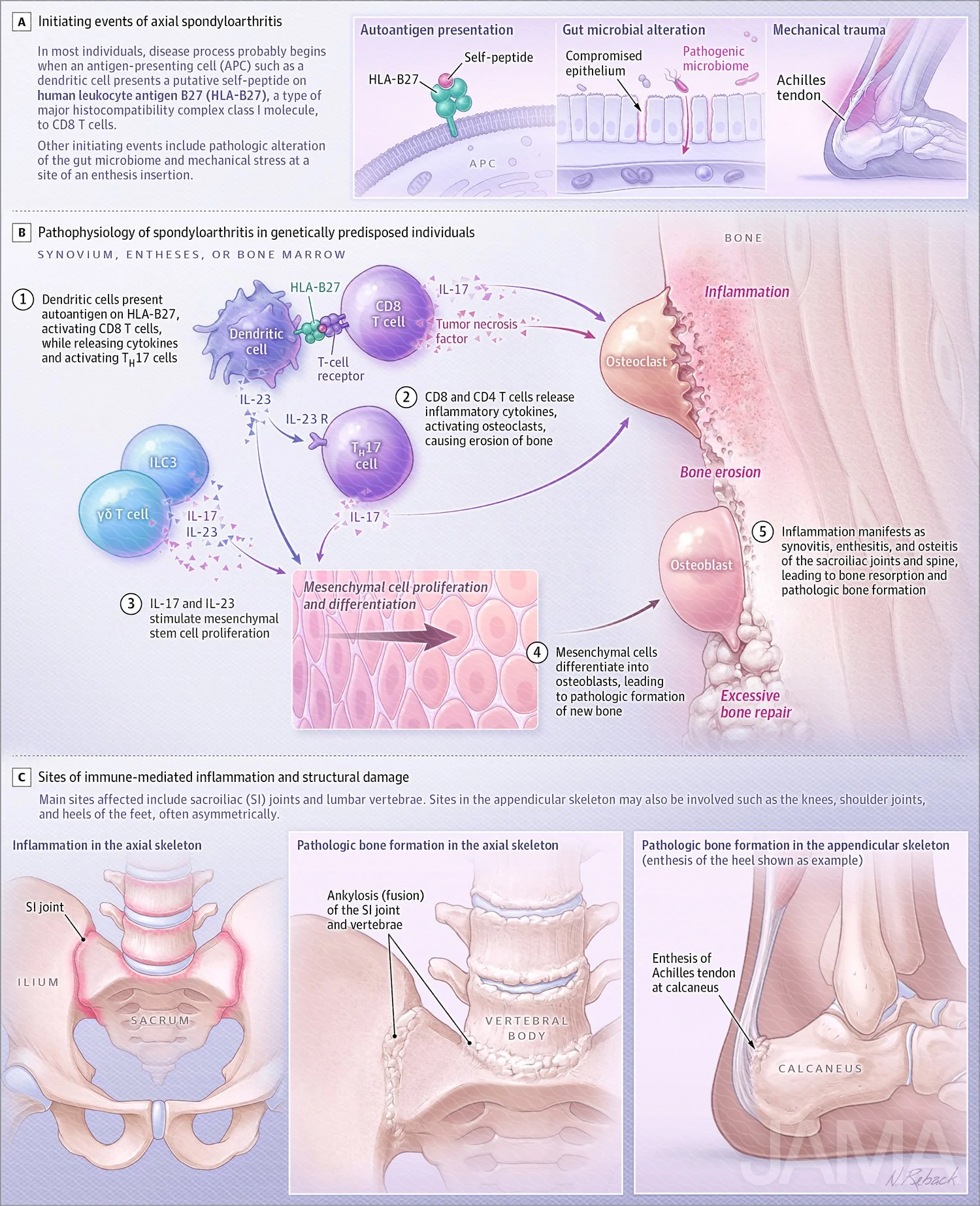 Spondyloarthritis