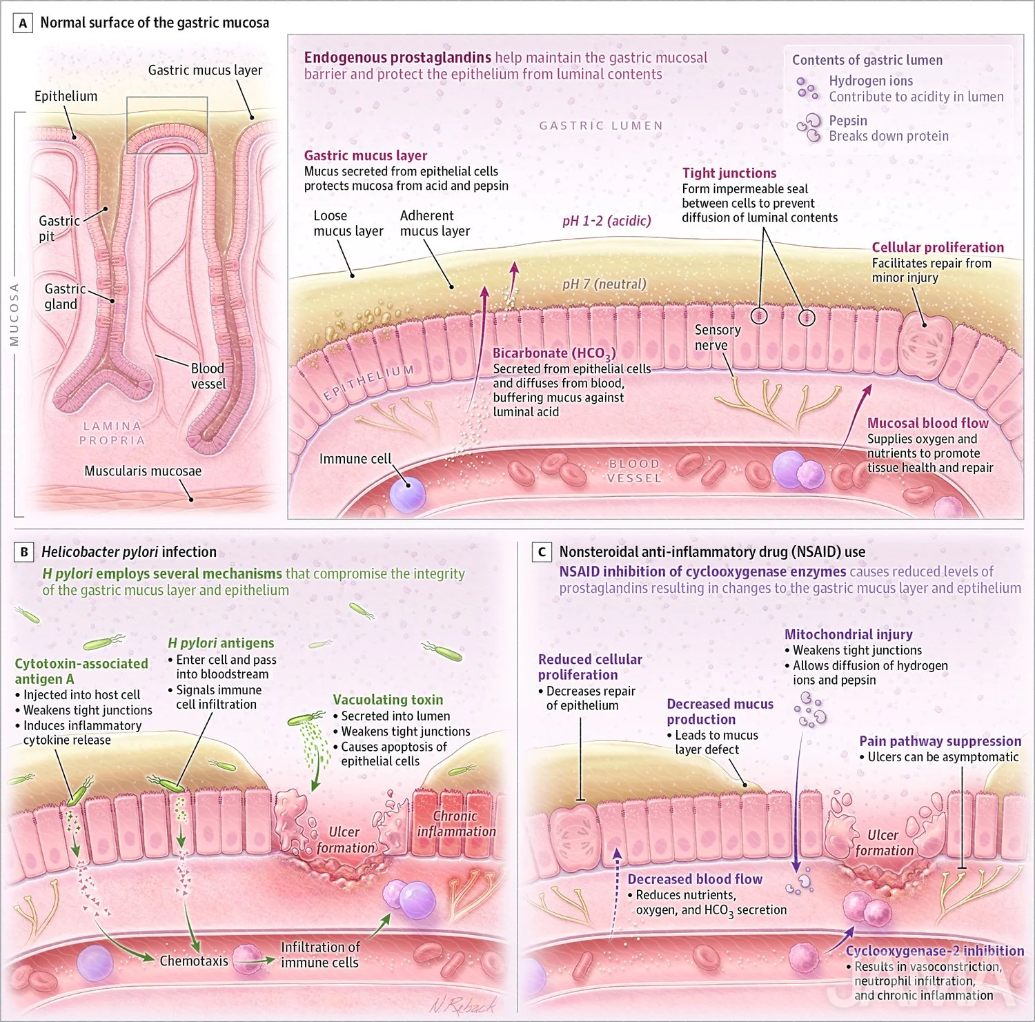Pathophysiology of gastric ulcers
