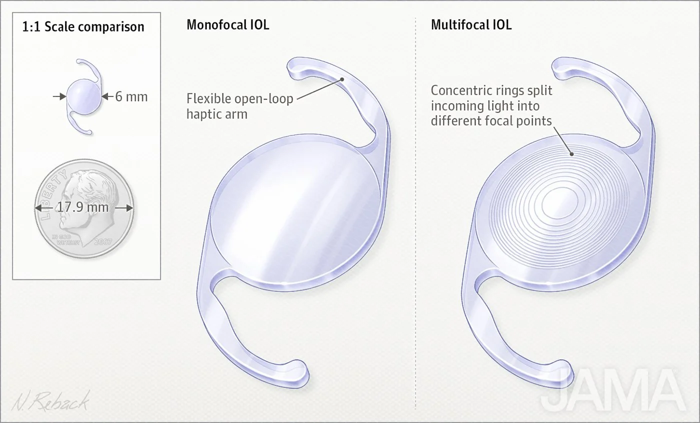 Cataracts surgery and focal lens replacements