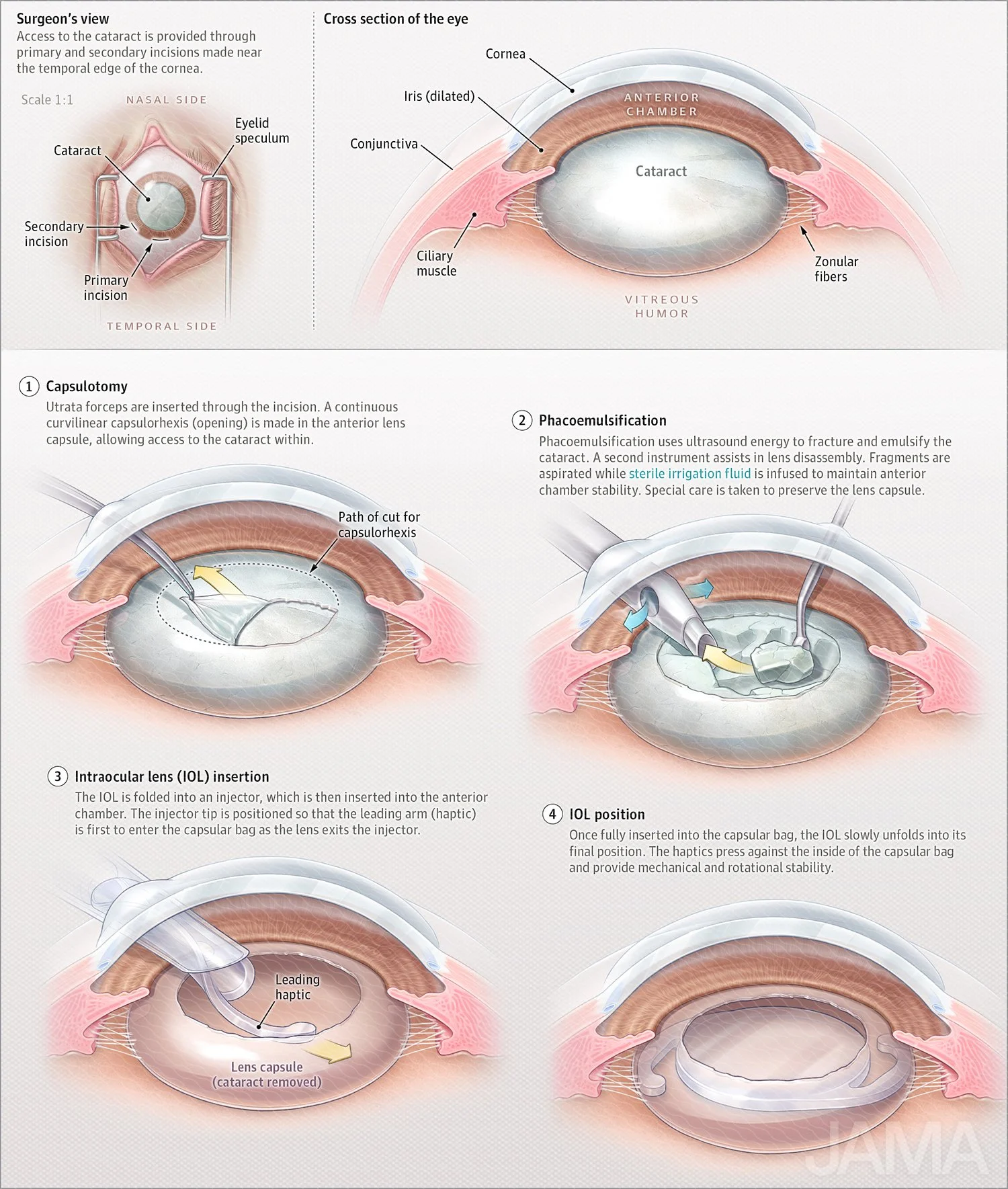 Cataracts surgery