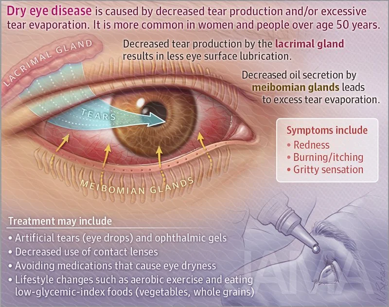 Dry eye disease