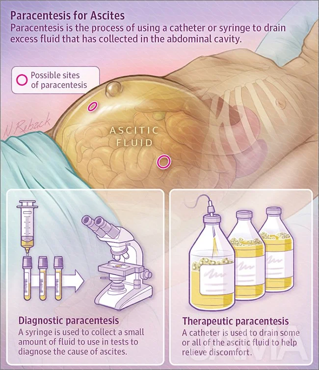 Paracentesis for Ascites