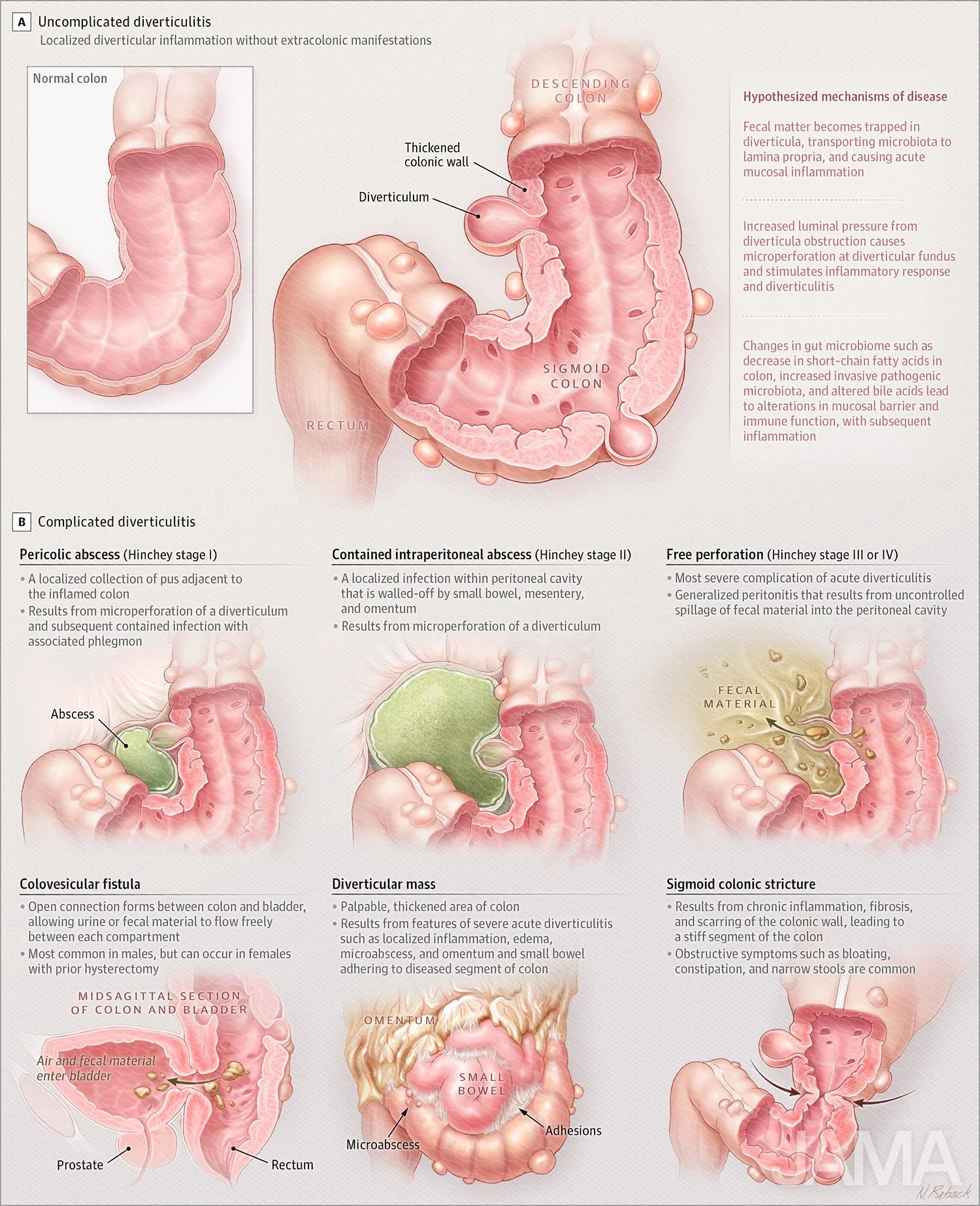 Pathology of diverticulitis