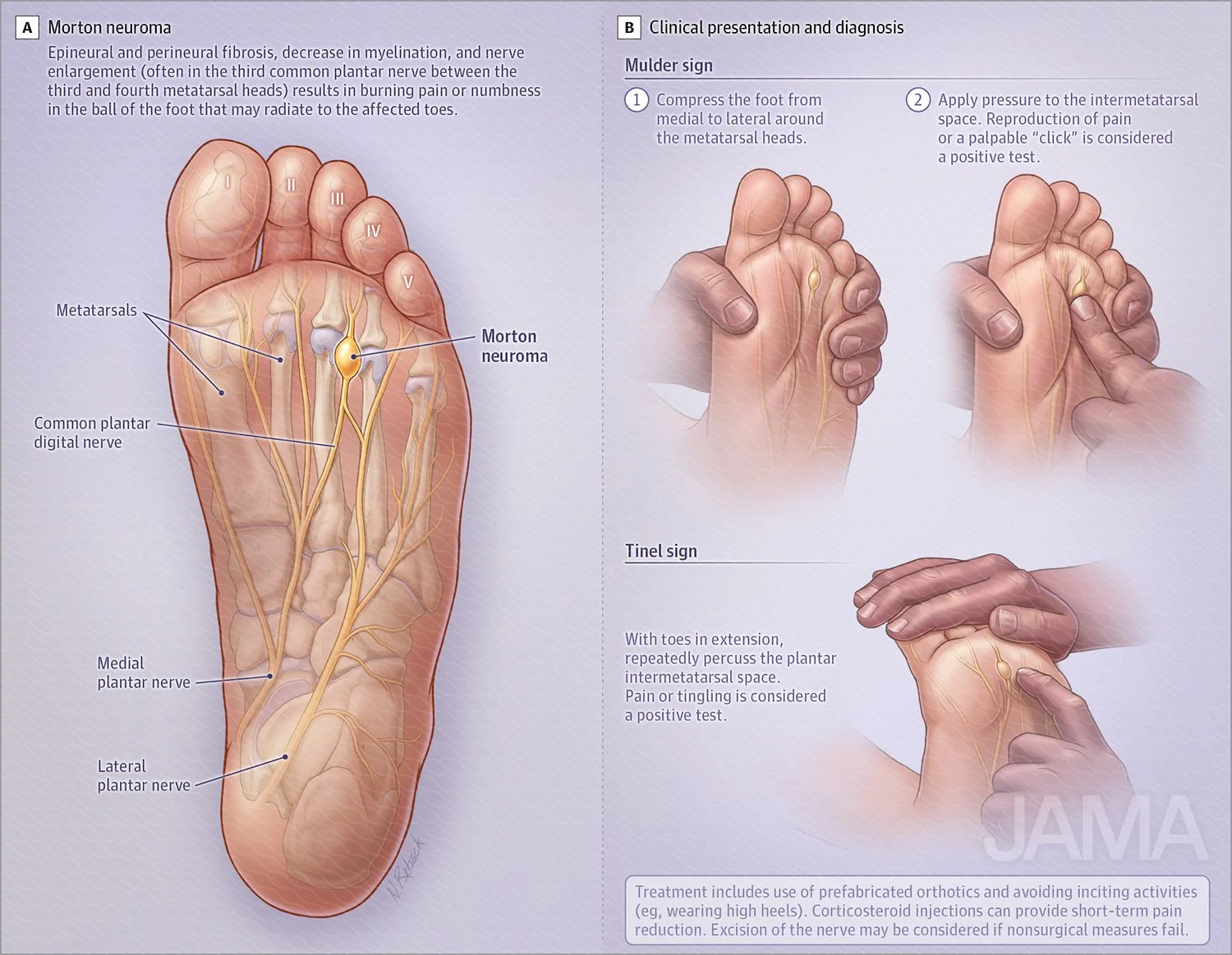 Mortons neuroma