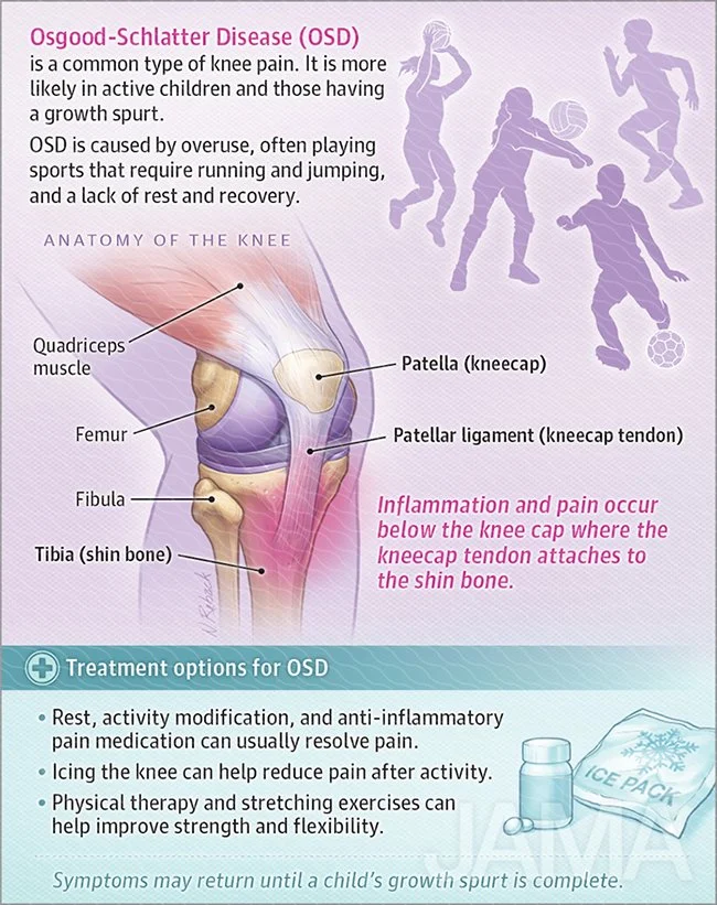 Osgood-Schlatter disease