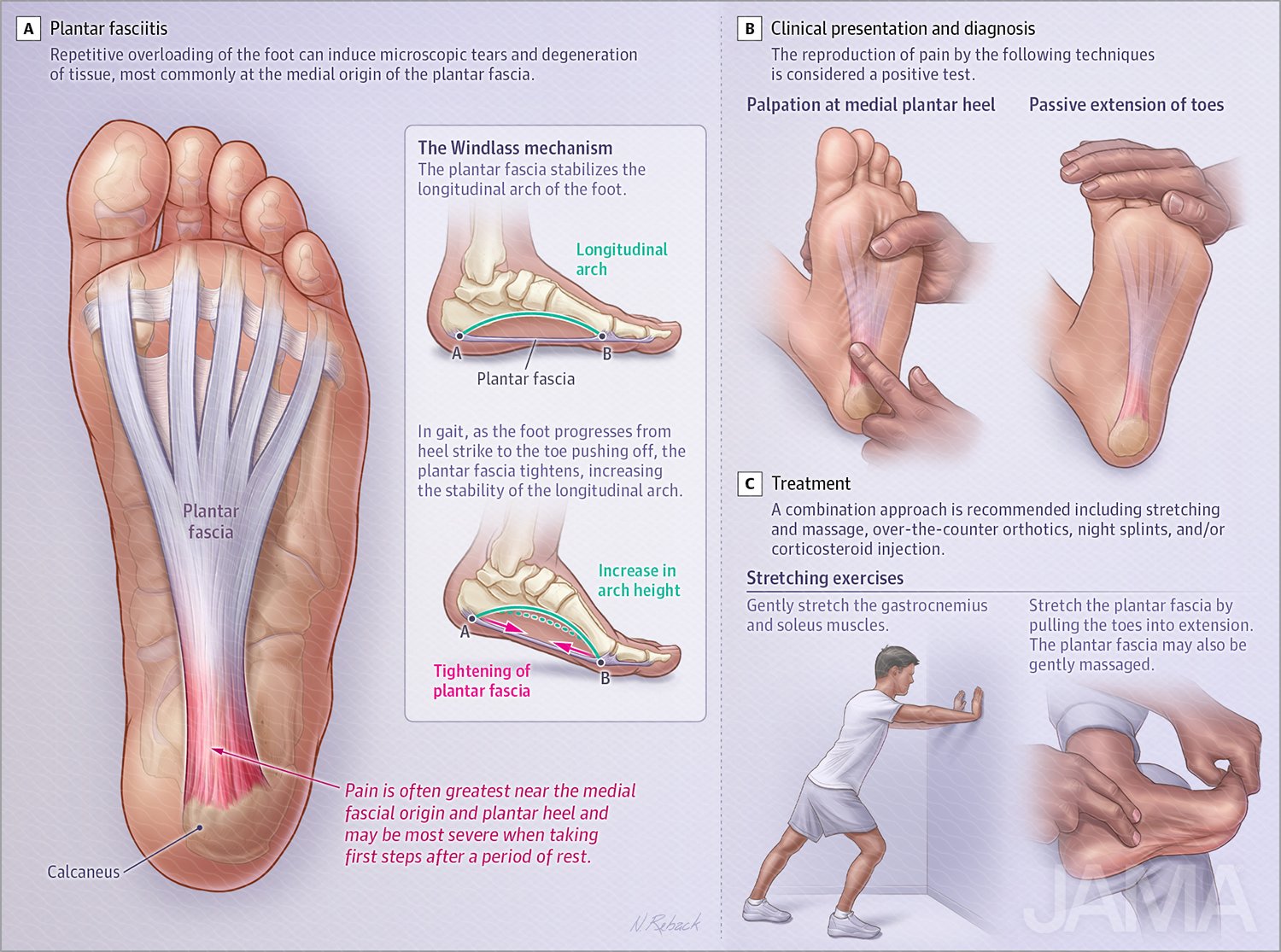 Plantar Fasciites