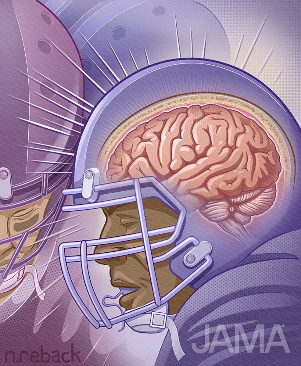 Subconcussive football hits may leave telltale sign of brain damage