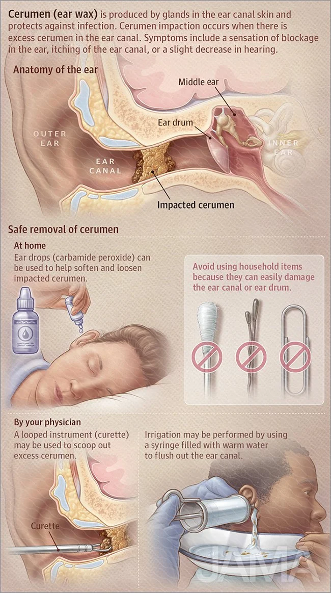 Cerumen impaction