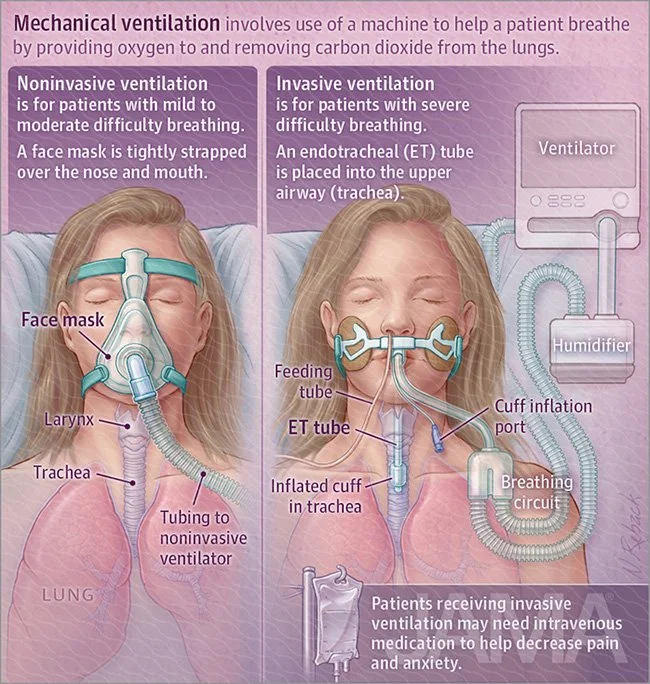 Mechanical ventilation