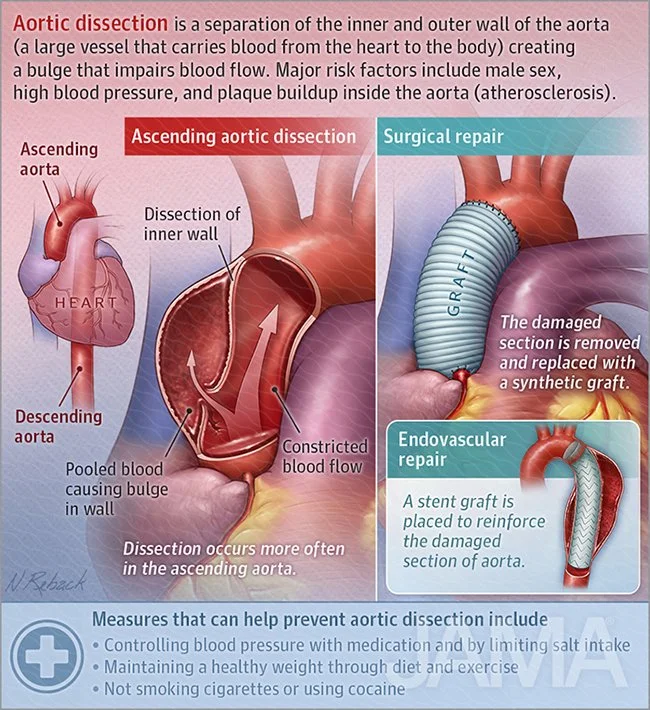 Aortic dissection