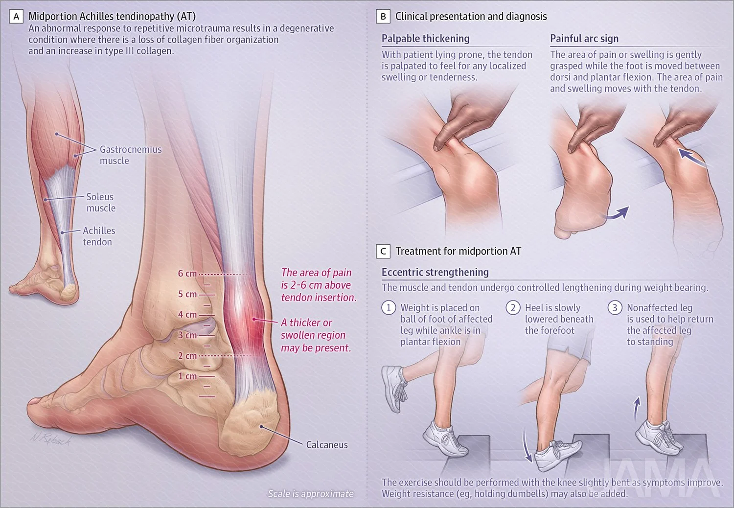 Achilles heel tendinopahty