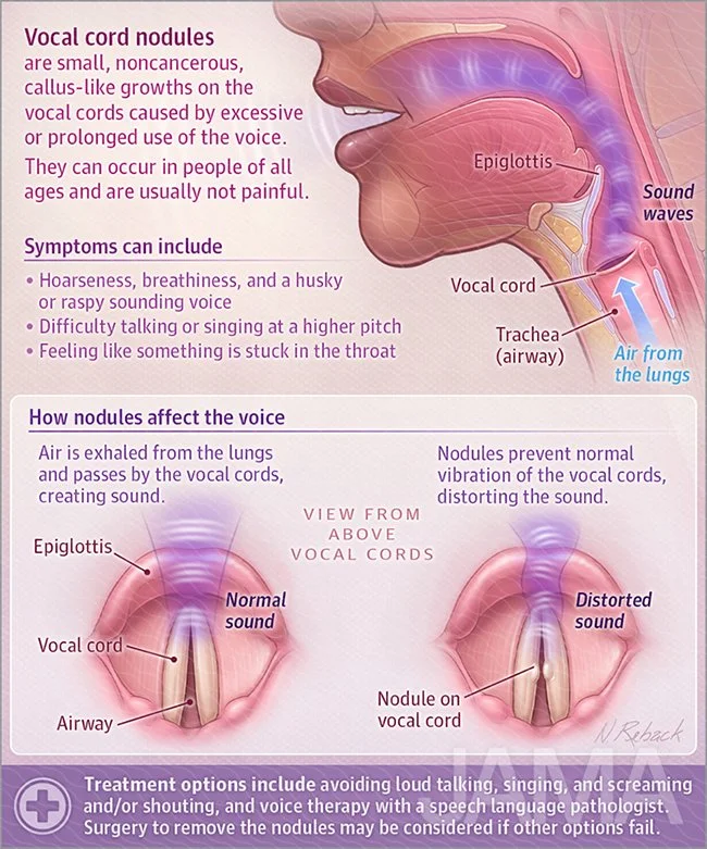 Vocal cord nodules
