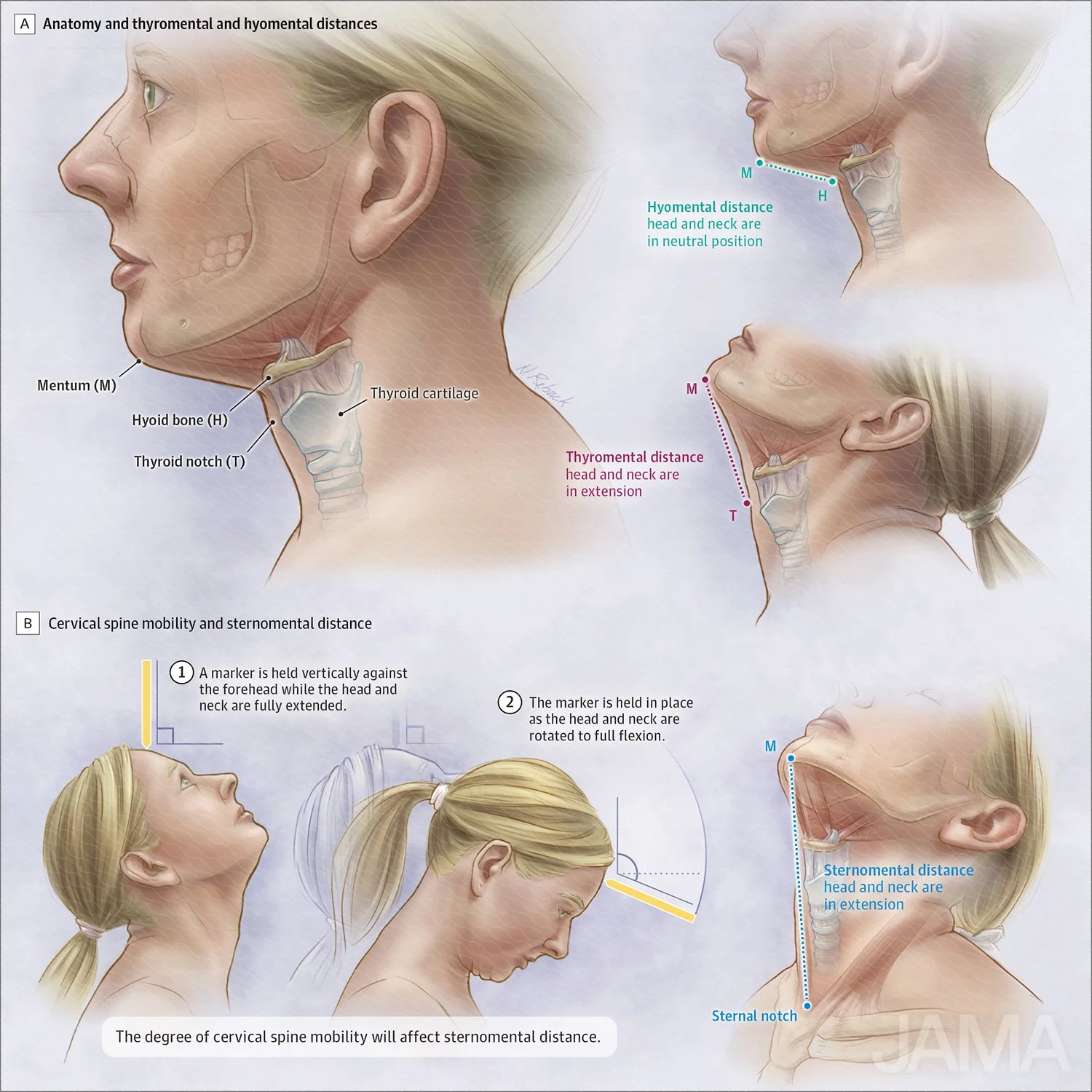 Assessment of difficult intubation