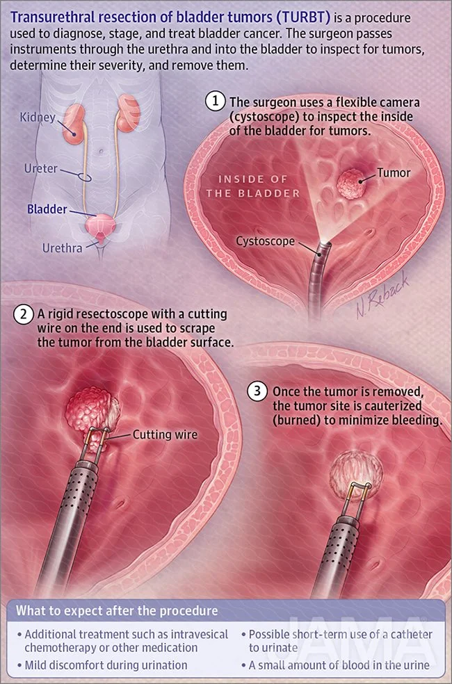 Resection of bladder tumors