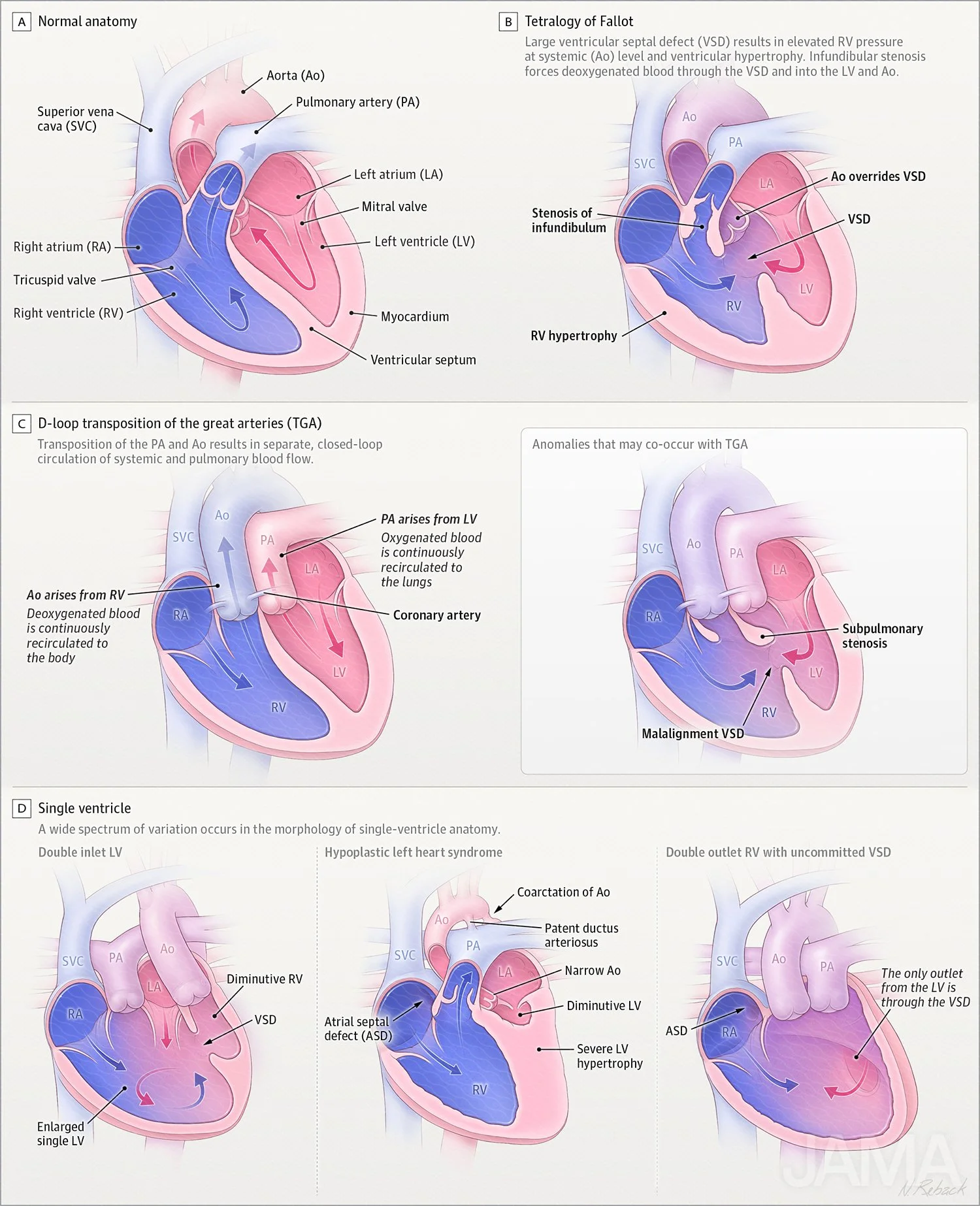 Cyanotic congenital heart diseases (CCHDs)
