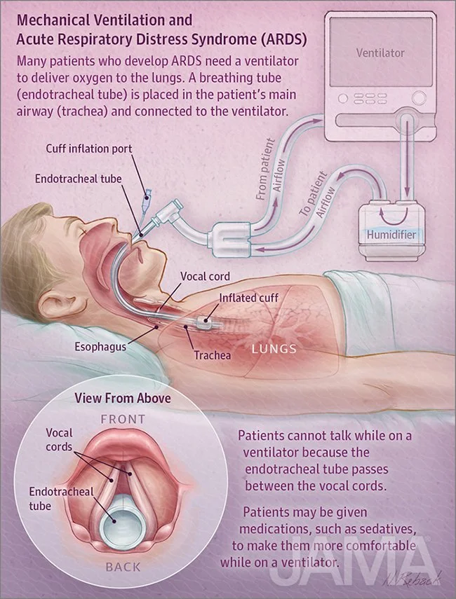 Mechanical ventilation and ARDS