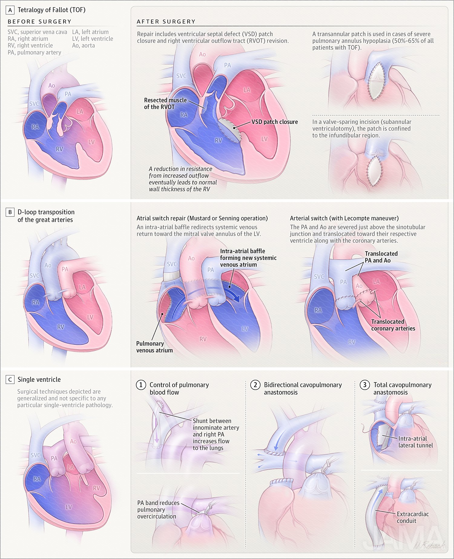 Surgical palliation for cyanotic congenital heart diseases (CCHDs) 