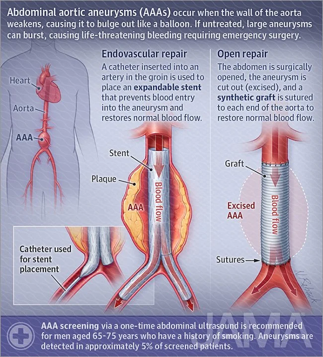 Abdominal aortic aneurysms