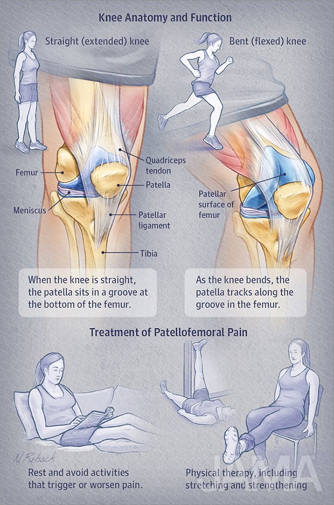 Patellofemoral pain