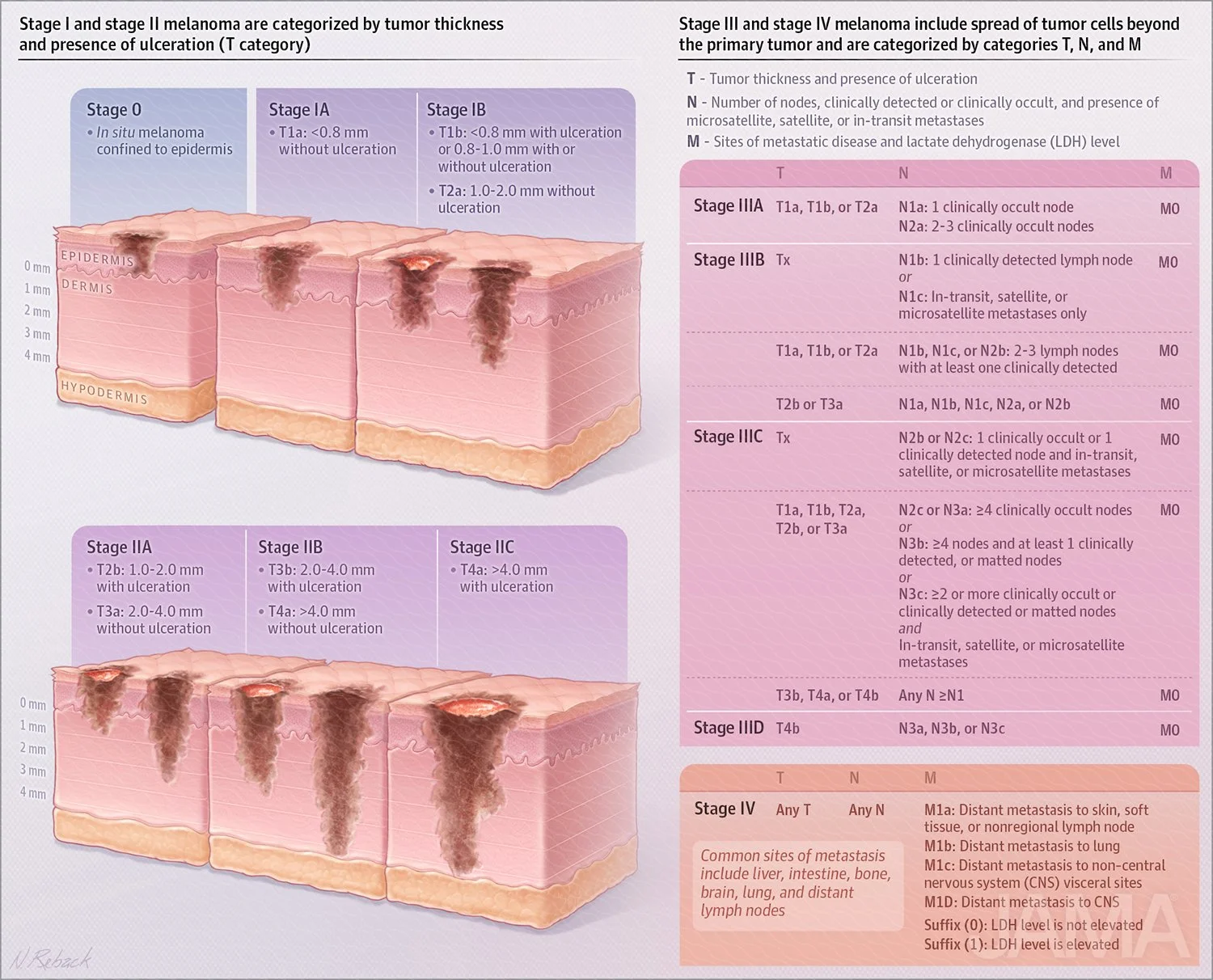 Stages of melanoma