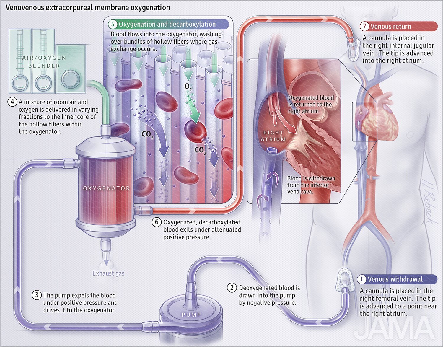 Extracorporeal membrane oxygenation