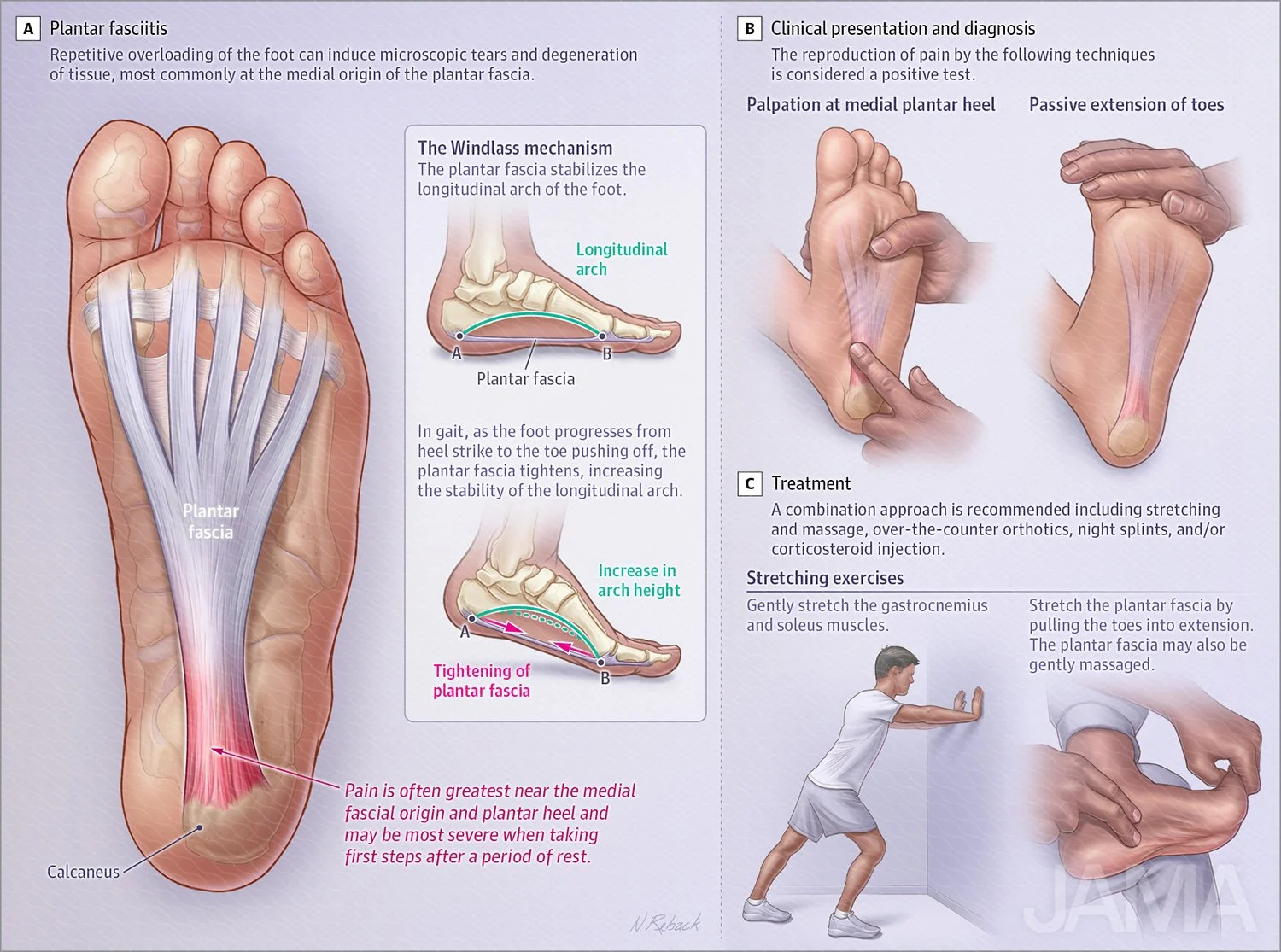 Plantar fasciitis