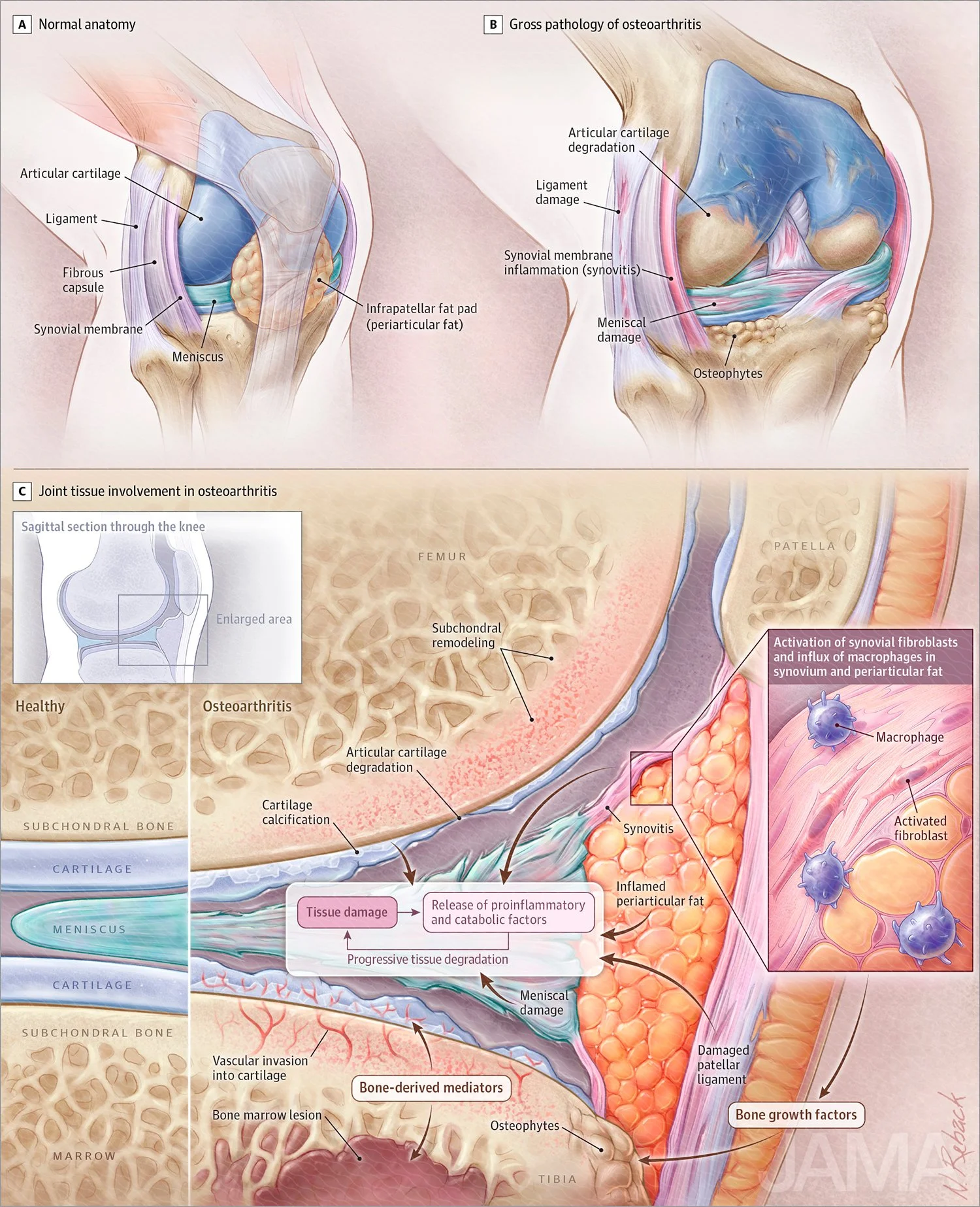 Knee osteoarthritis