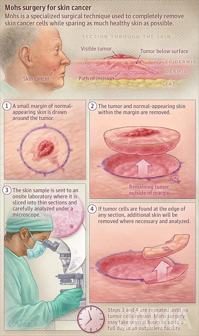 Moh's surgery