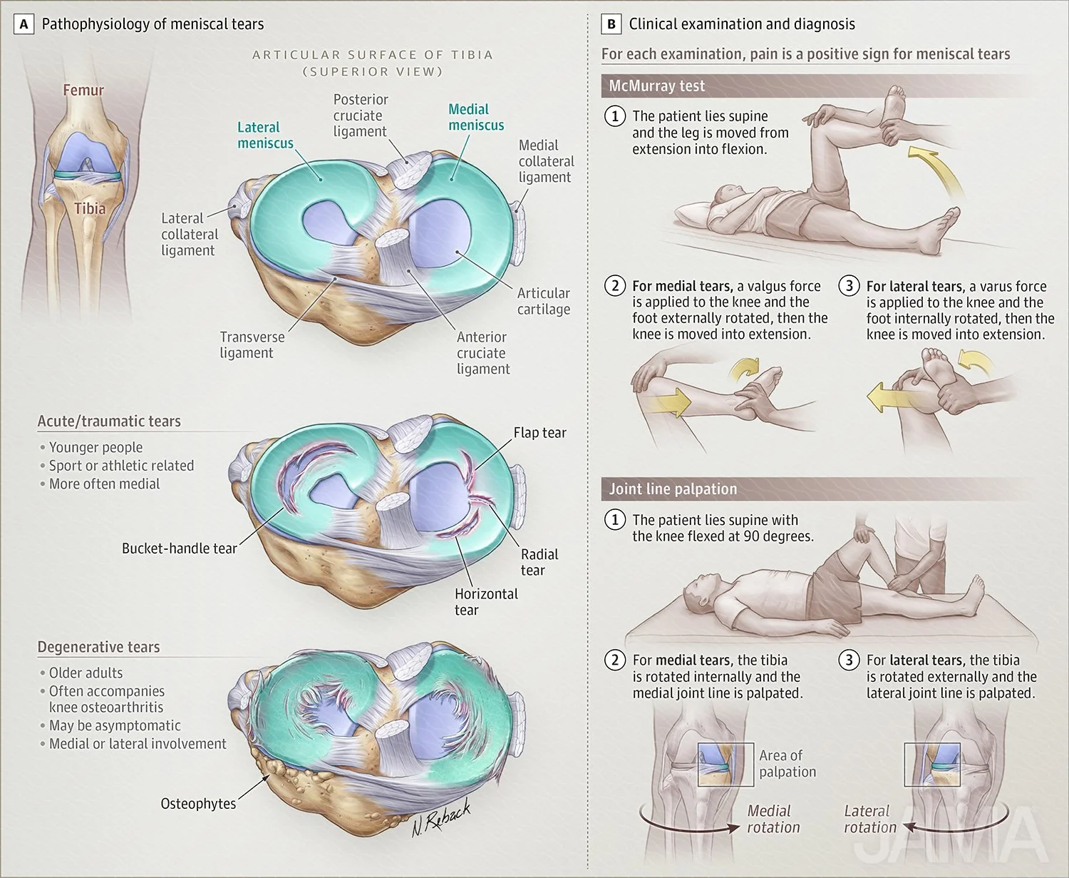 Pathology of meniscal tears