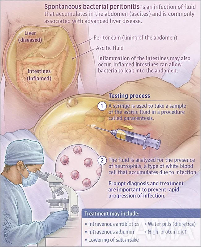 Spontaneous bacterial peritonitis