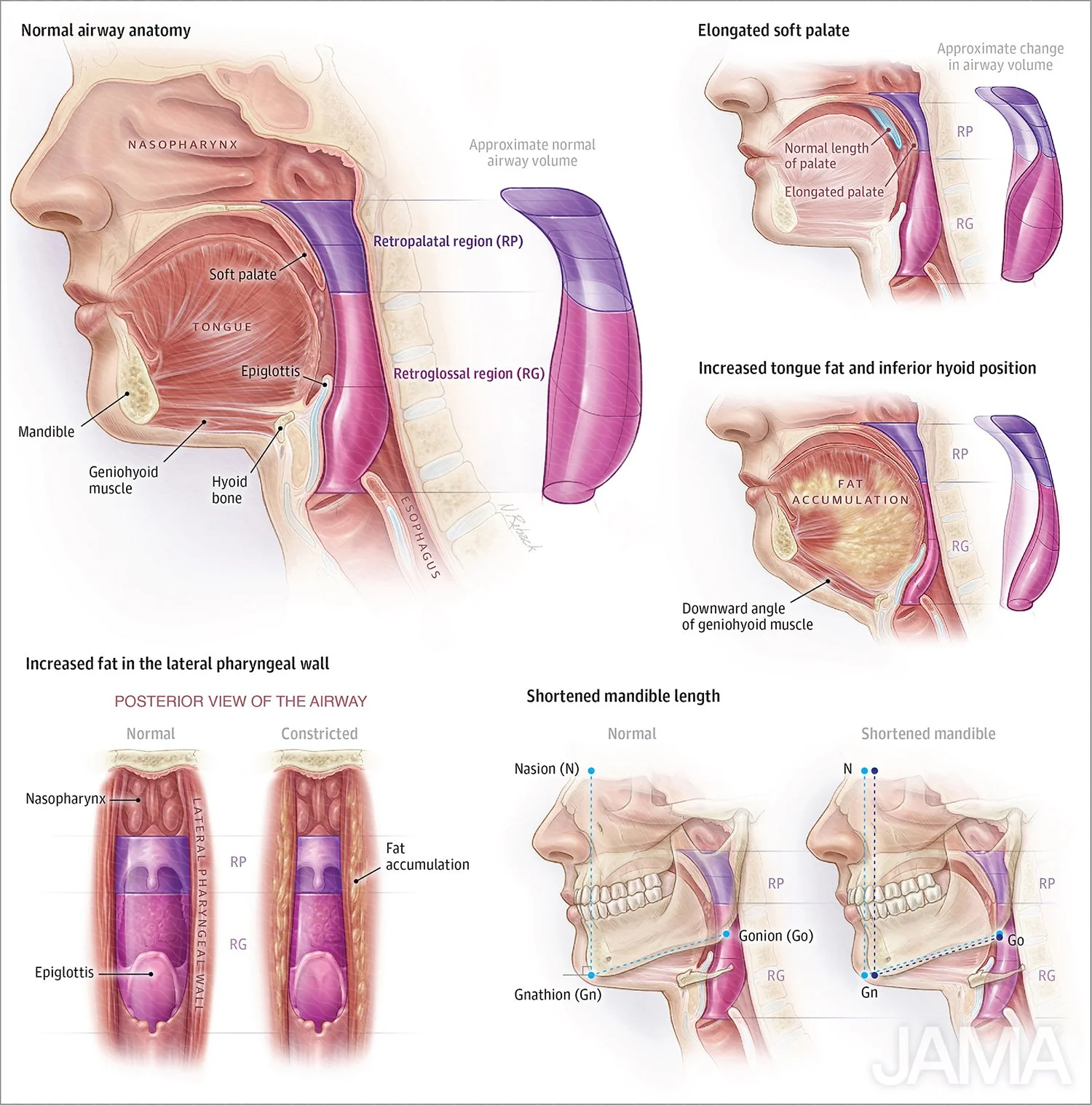 Obstructive sleep apnea