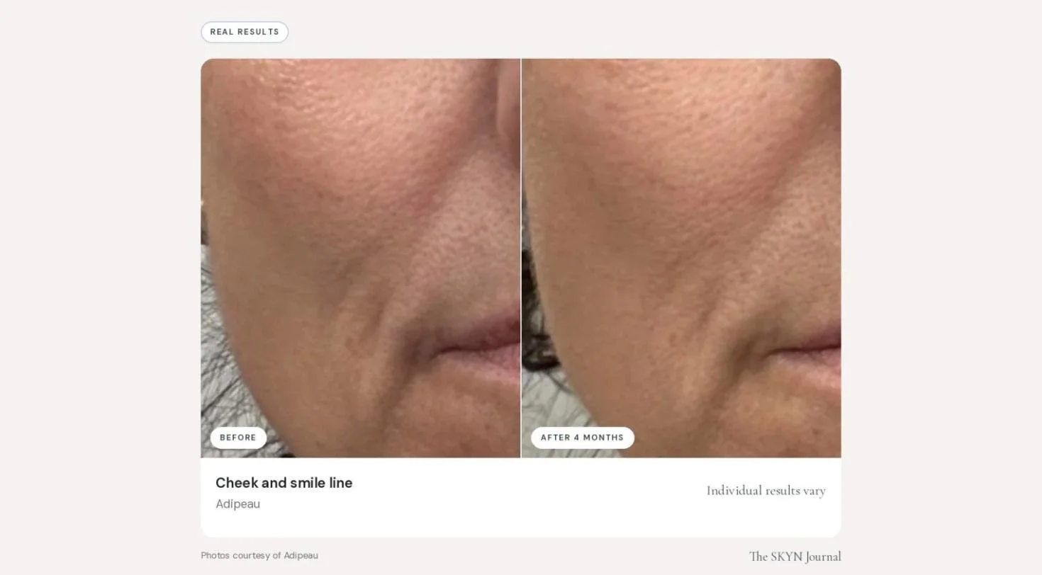 adipeau_before_after_01.jpg