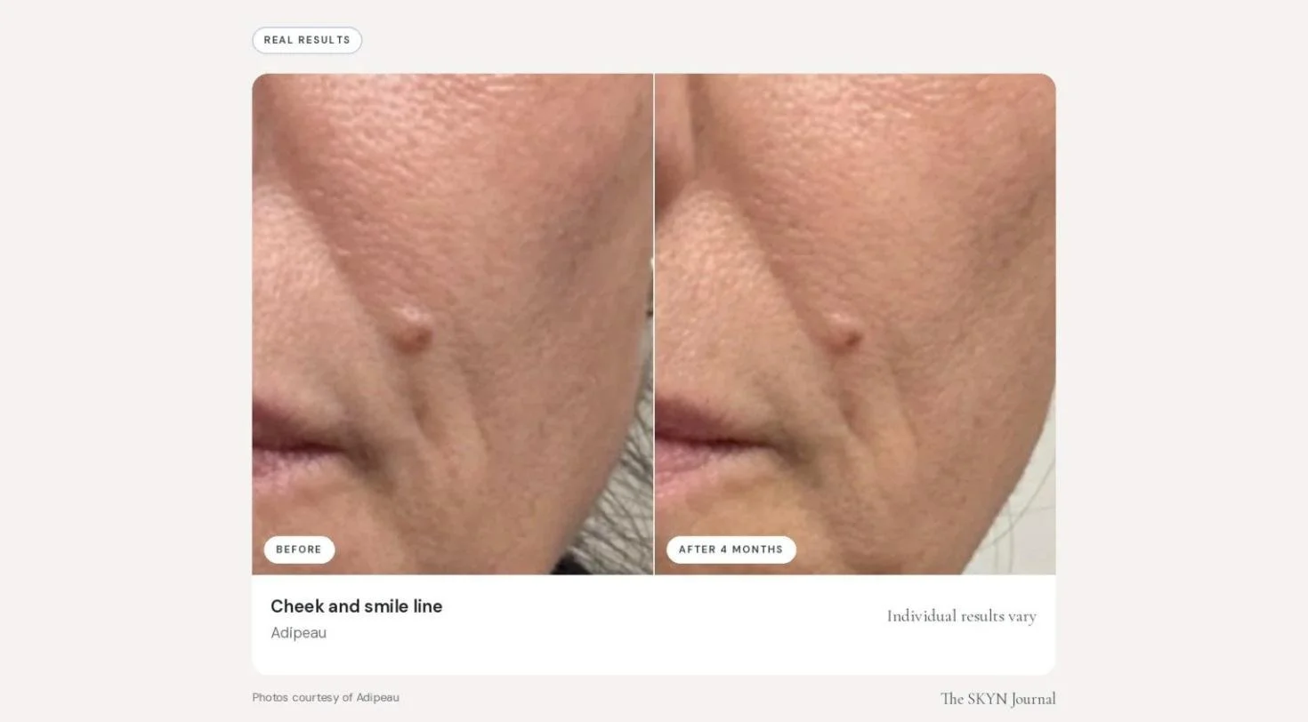 adipeau_before_after_02.jpg