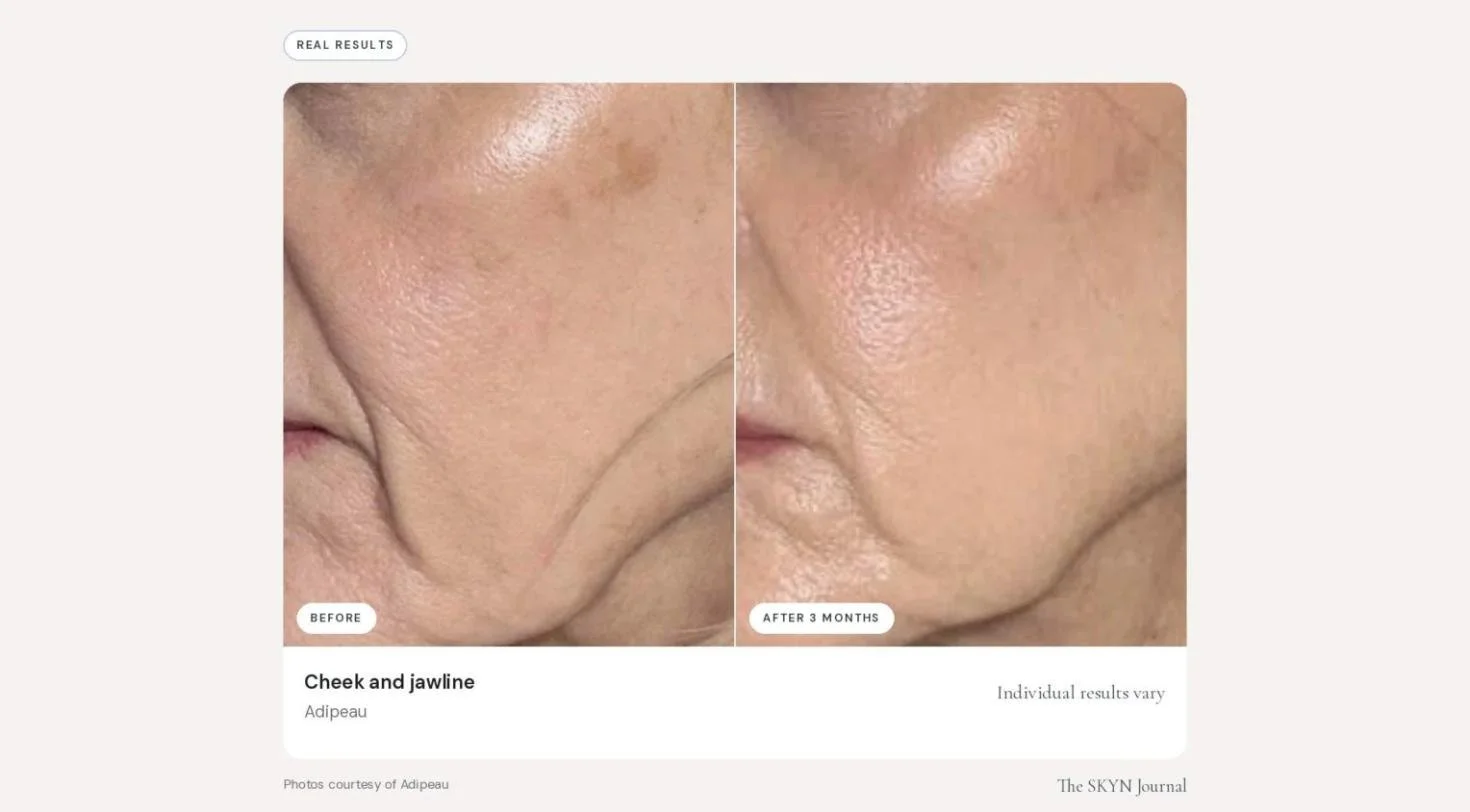 adipeau_before_after_03.jpg