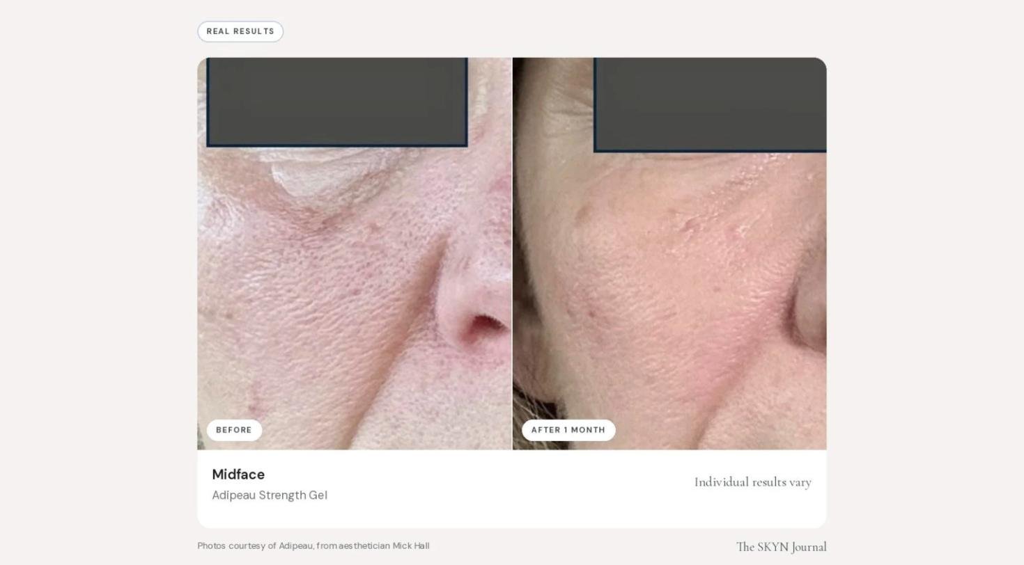 adipeau_before_after_04.jpg