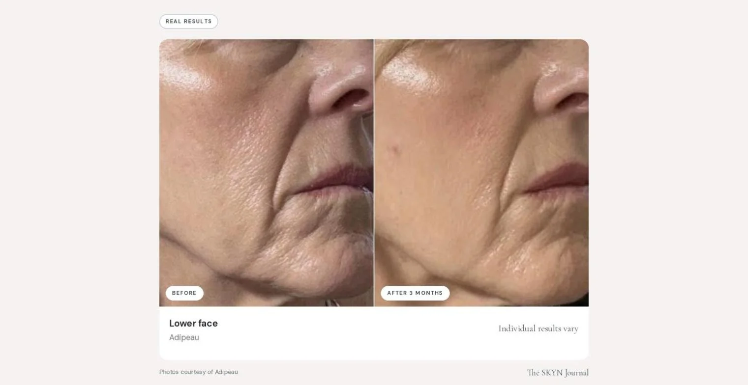 adipeau_before_after_07.jpg