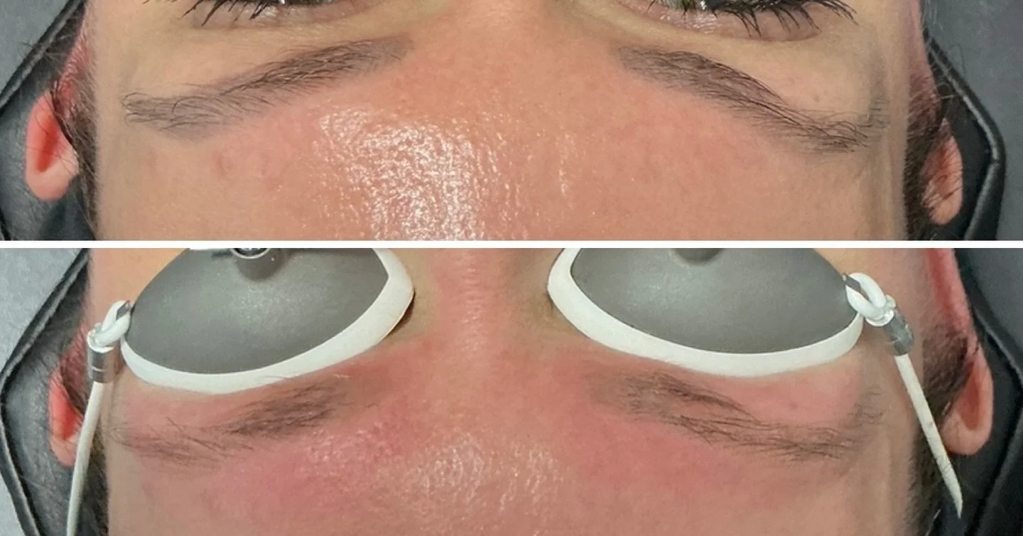 Cosmetic ink removal for my amazing client!🖤⚡️

#lasertattooremoval #lasertattooremovalspecialist #hollywoodspectra #tattoo #tattooremoval