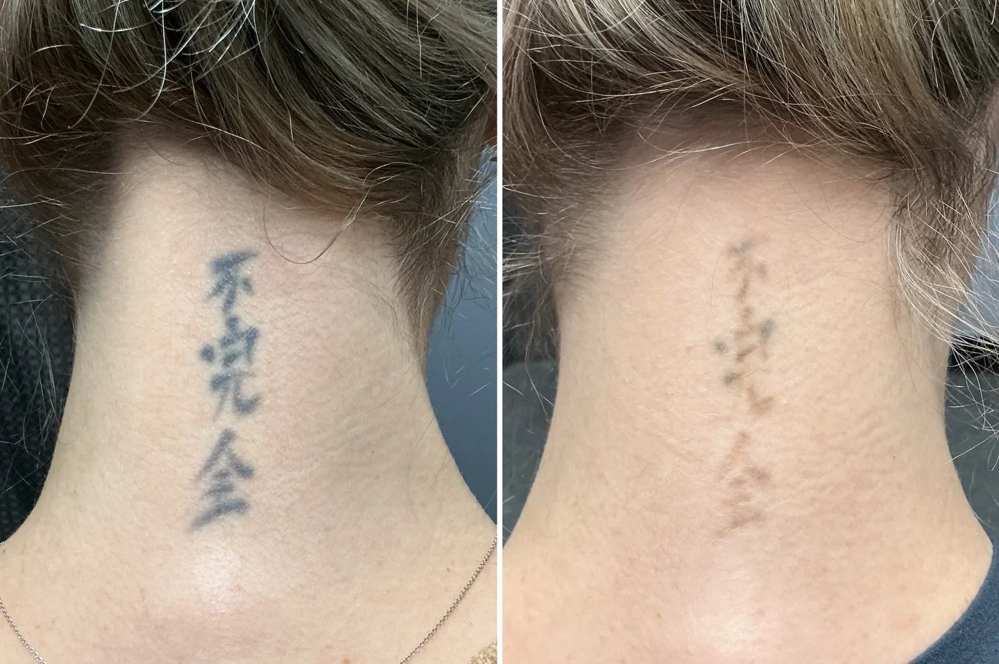 First treatment results on my lovely client!

#tattooremoval #tattooremovalspecialists #tattoos #hollywoodspectra #lasertattooremoval