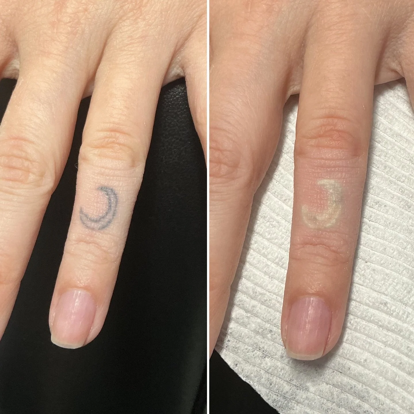 1st treatment frost >>> she will only need a few sessions to remove this! 🌙 

@lutronic_us 

#412 #tattooremoval #tattoo #lasertattooremoval #pittsburgh