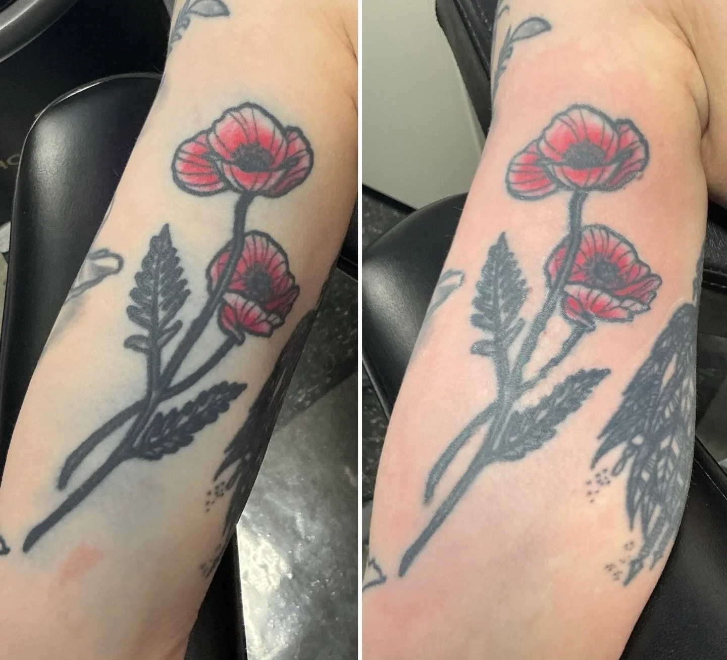 Blowout removal in one session! 🌺 

@lutronic_us 
#412 #tattoo #lasertattooremoval #tattooremoval #pittsburgh
