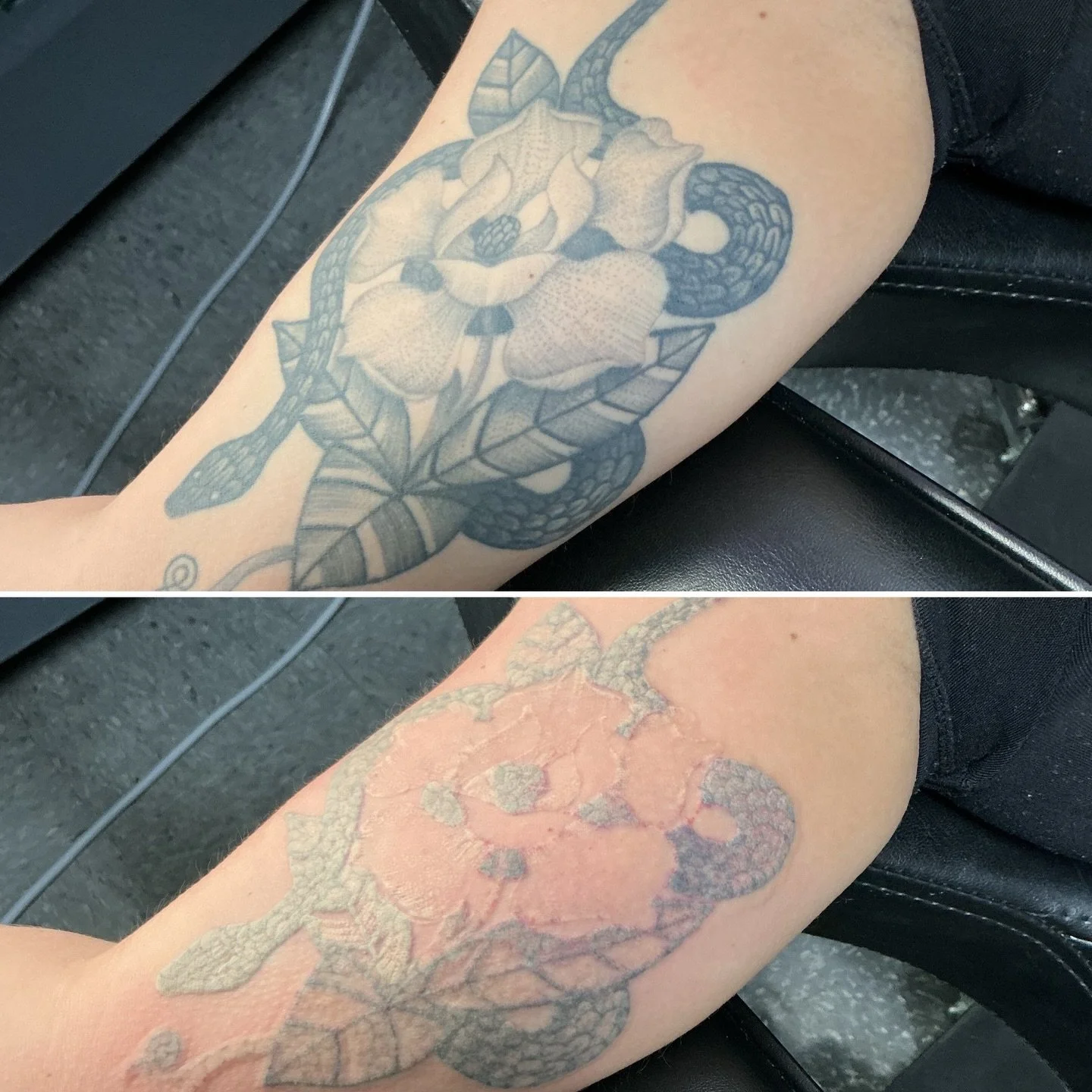 Since it&rsquo;s not applied as densely as liner needle, most shading fades completely in the first treatment! 

@lutronic_us 

#lasertattooremoval #412 #pittsburgh #tattooremoval #tattoos