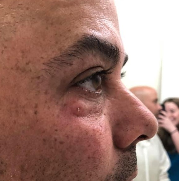 Close-up of a man's face showing skin blemishes, freckles, and a pimple near the eye, with a blurred background including two people.