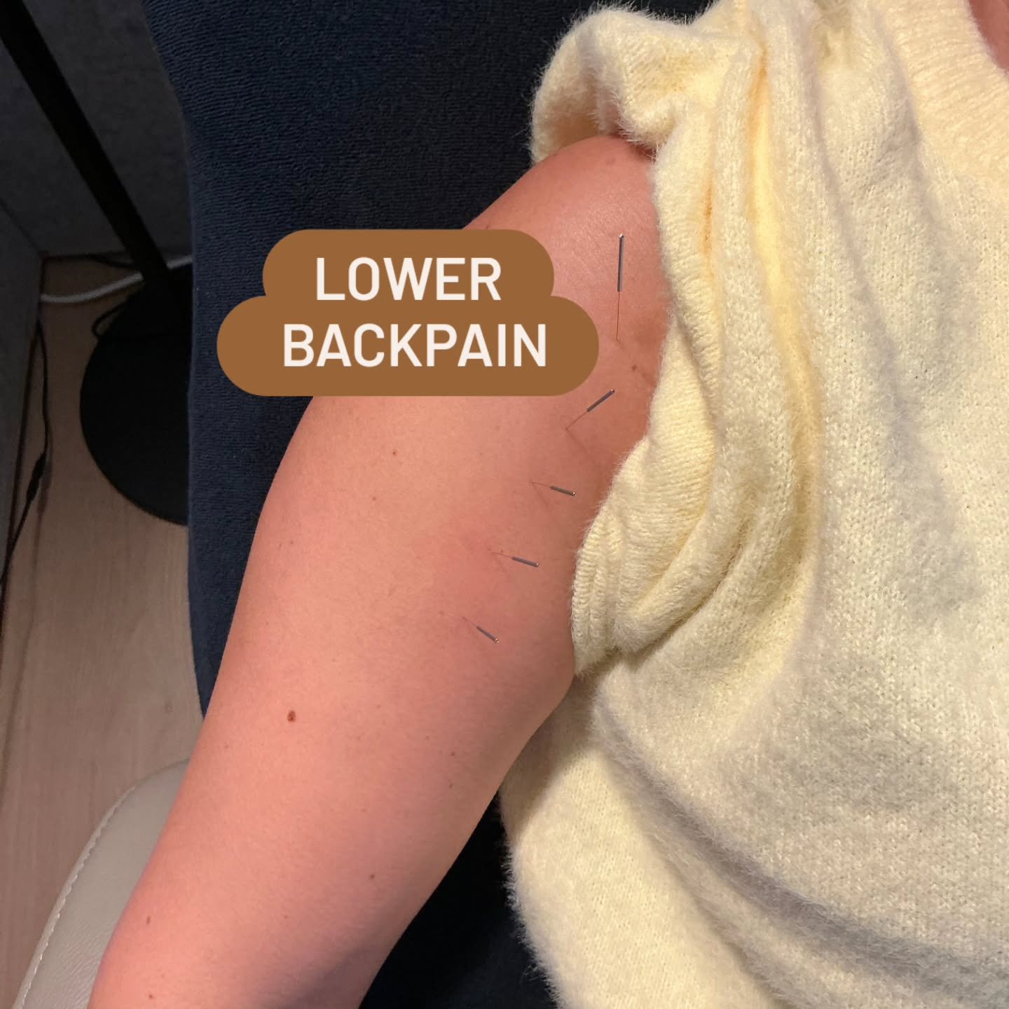 Needling along the LU meridian for UB meridian BACKPAIN.

Follow us for more balance method info! @drtanbalancemethod

#drtan #acupuncture #balancemethodacupuncture