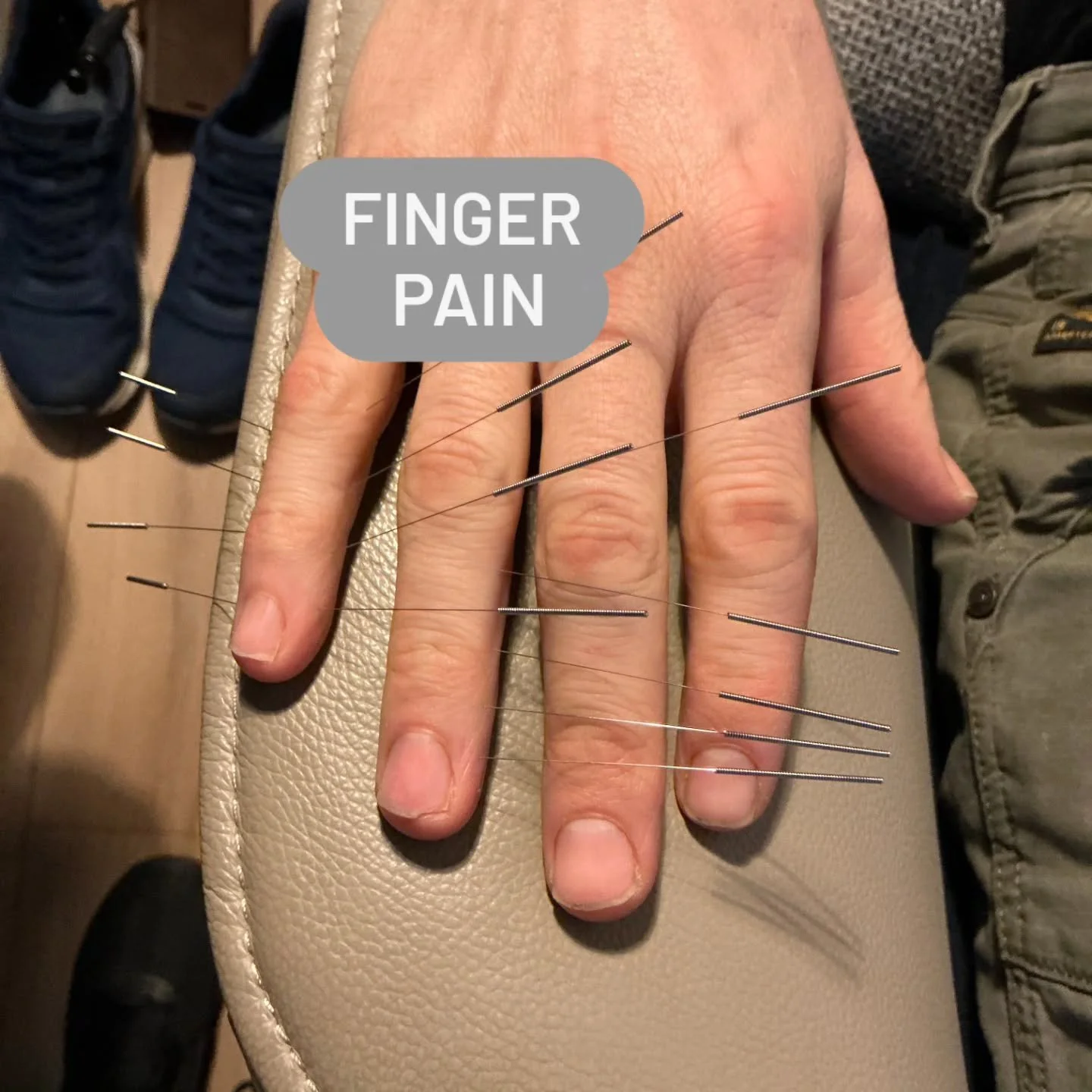 Needling on the yang ming line and the tai yang line of the pinky finger for same pain on the opposite pinky.
Extra needling on the yang ming line of the ring finger for same pain on the opposite ring finger.

Follow us for more balance method info! 