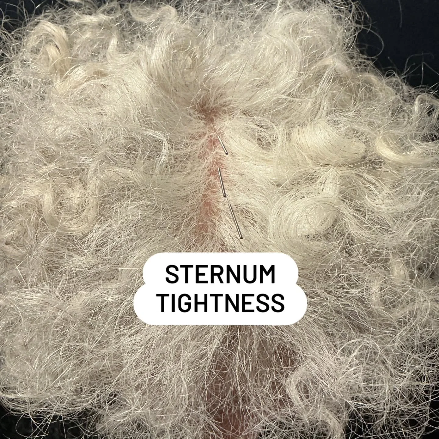 Needling along the Dumai meridian for Renmai tightness while breathing, instant relief.

Follow us for more balance method info! @drtanbalancemethod

#drtan #acupuncture #balancemethodacupuncture