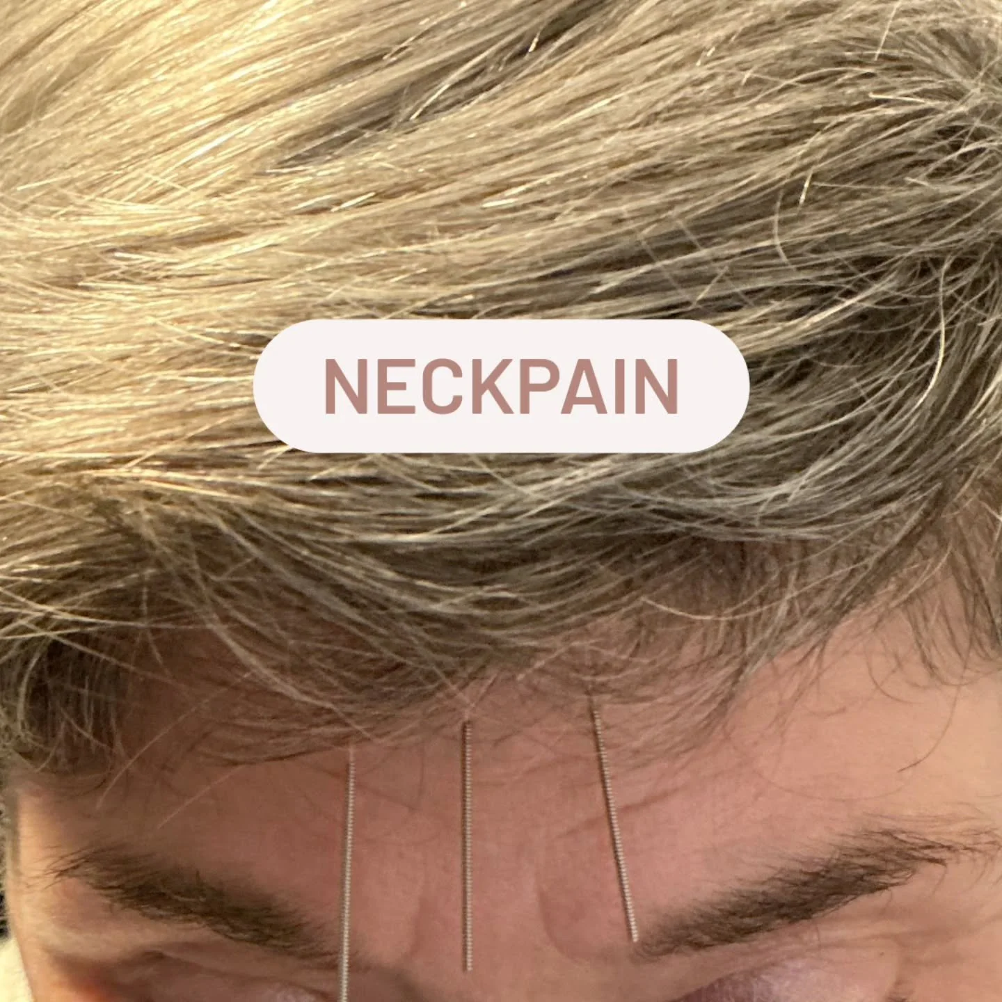 Needling on the scalp for neckpain along UB meridian and Dumai.

Follow us for more balance method info! @drtanbalancemethod

#drtan #acupuncture #balancemethodacupuncture