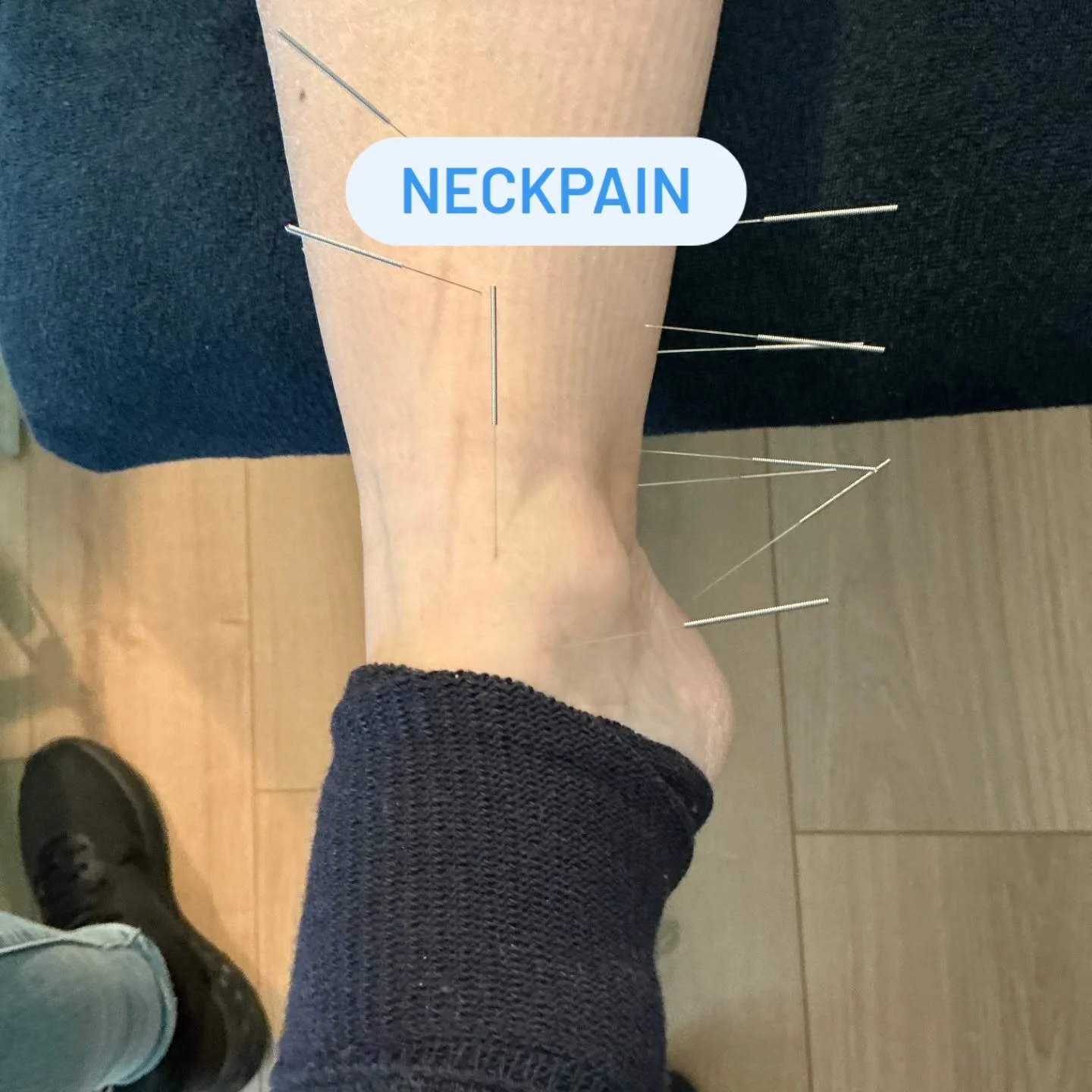Needling along LIV, KID and SP meridian for severe neckpain. 

Follow us for more balance method info! @drtanbalancemethod

#drtan #acupuncture #balancemethodacupuncture