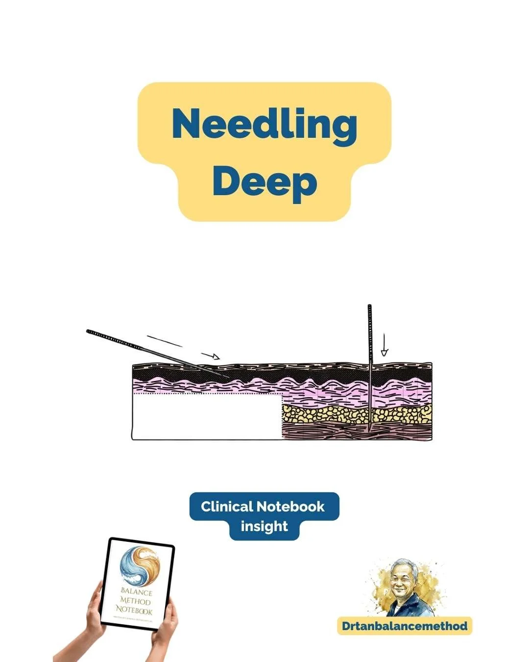Needling-deep-dr-tan-balance-method.jpg