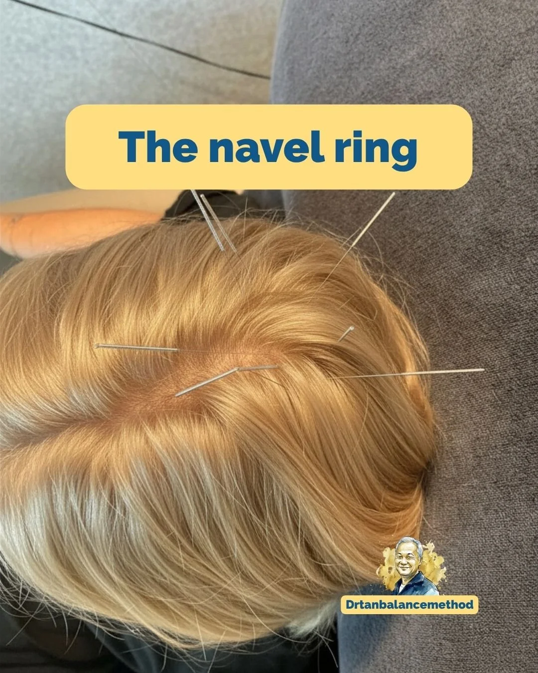 dr tan balance method scalp acupuncture.jpg